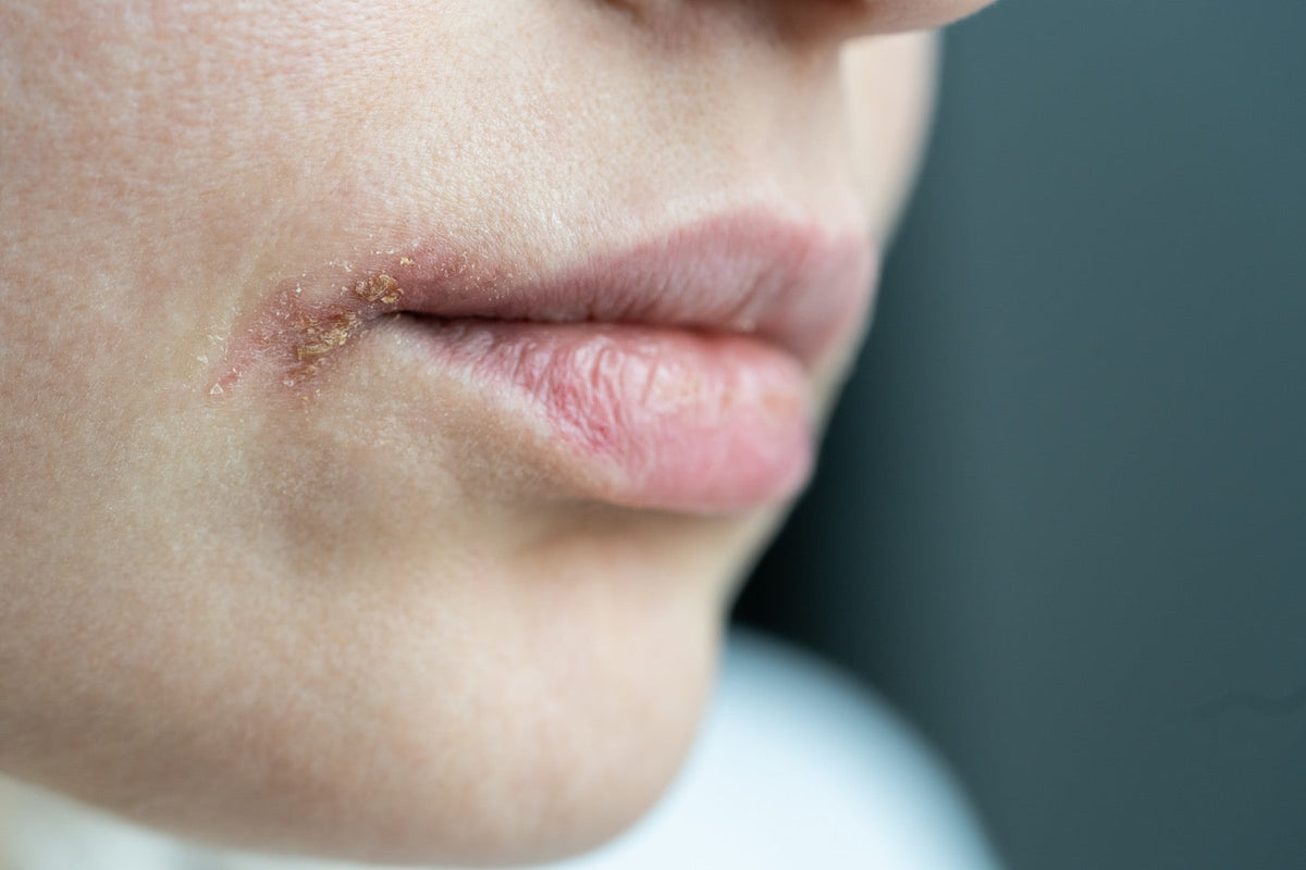 herpès labial lysine